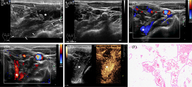 Usefulness of contrast-enhanced ultrasound in the diagnosis of neck cavernous hemangioma in adults