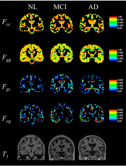 Longitudinal analysis of brain structure using existence probability