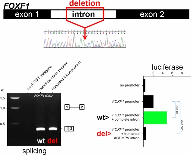 Novel FOXF1 Deep Intronic Deletion Causes Lethal Lung Developmental Disorder, Alveolar Capillary Dysplasia with Misalignment of Pulmonary Veins