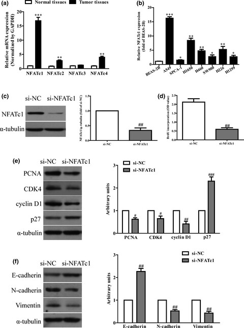 MiR-338 regulates NFATc1 expression and inhibits the proliferation and epithelial-mesenchymal transition of human non-small-cell lung cancer cells