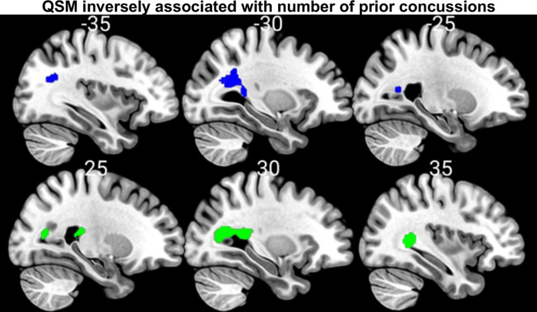 Investigating the Association of Concussion and Contact Sport Exposure History With Brain Microstructure Using Quantitative Susceptibility Mapping