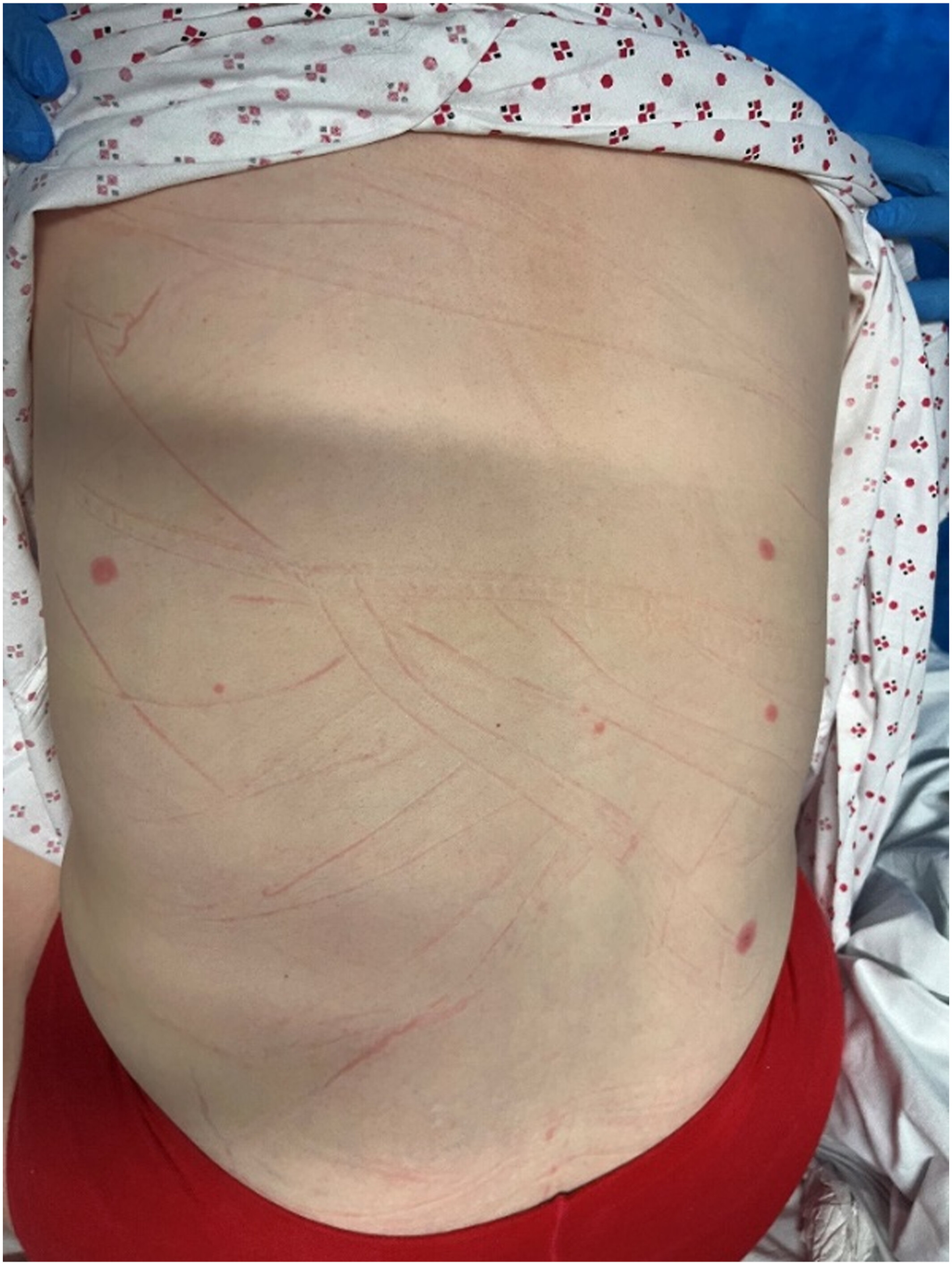 A case of Mycoplasma pneumoniae-induced rash and mucositis with recent influenza vaccination