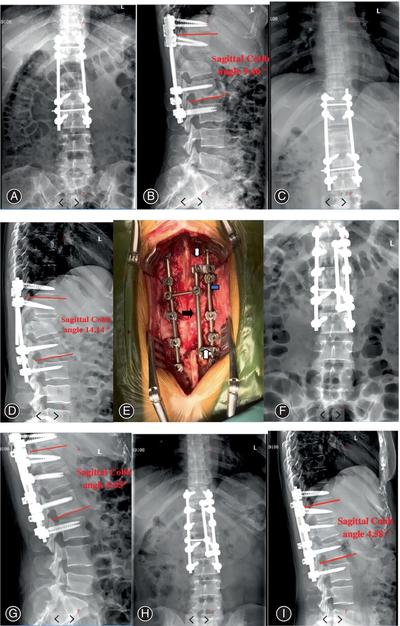 Application of Multi-Rod Constructs for the Revision of Thoracolumbar Fractures