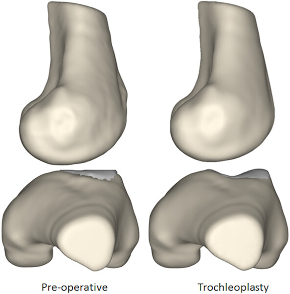 Groove-deepening trochleoplasty reduces lateral patellar maltracking and increases patellofemoral contact pressures: Dynamic simulation