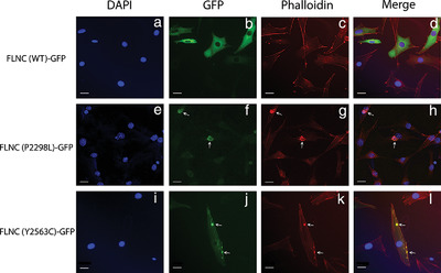 Novel pathogenic variants in filamin C identified in pediatric restrictive cardiomyopathy