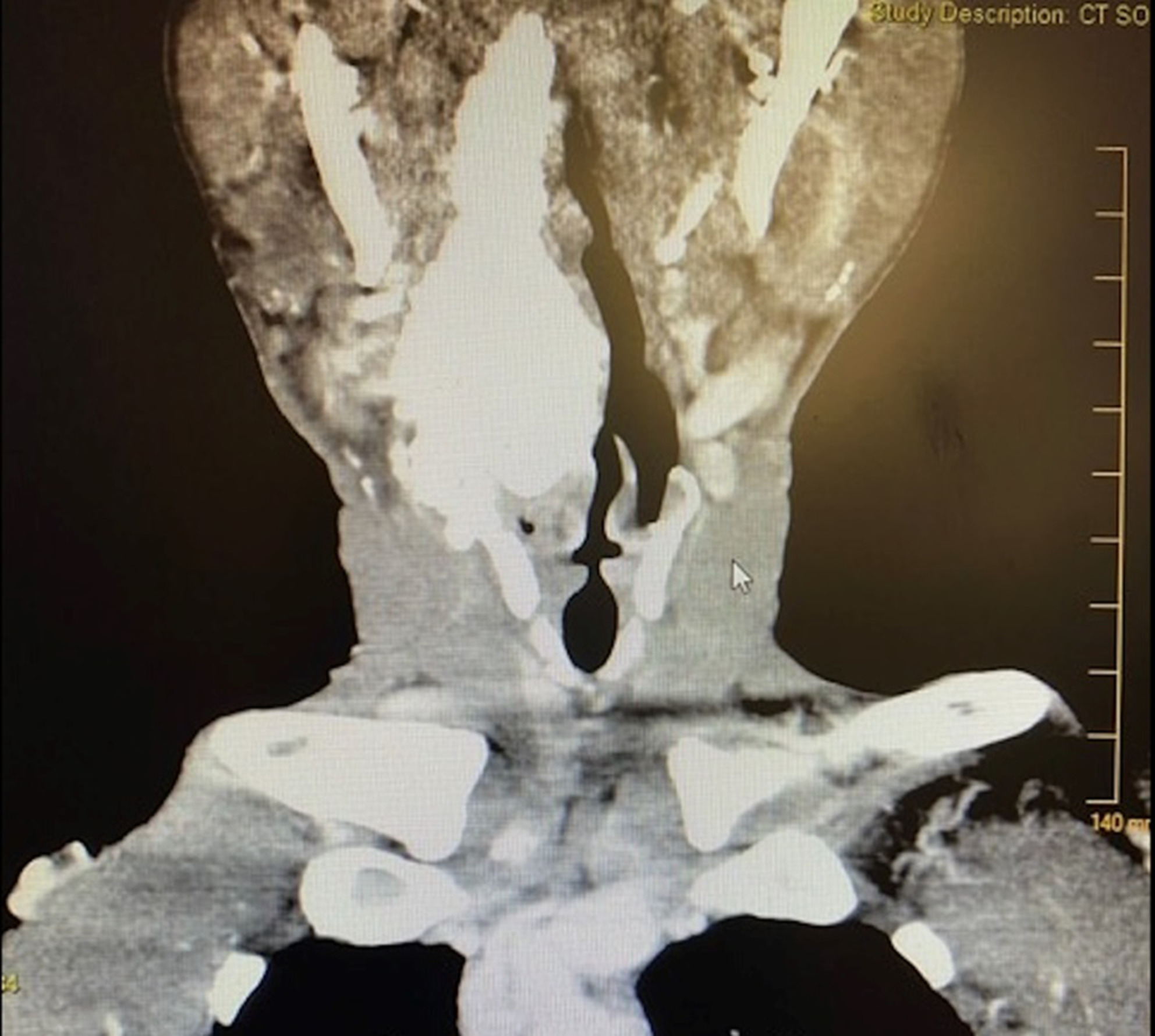 Calcinosis of the internal jugular vein: Interesting presentation of tertiary hyperparathyroidism