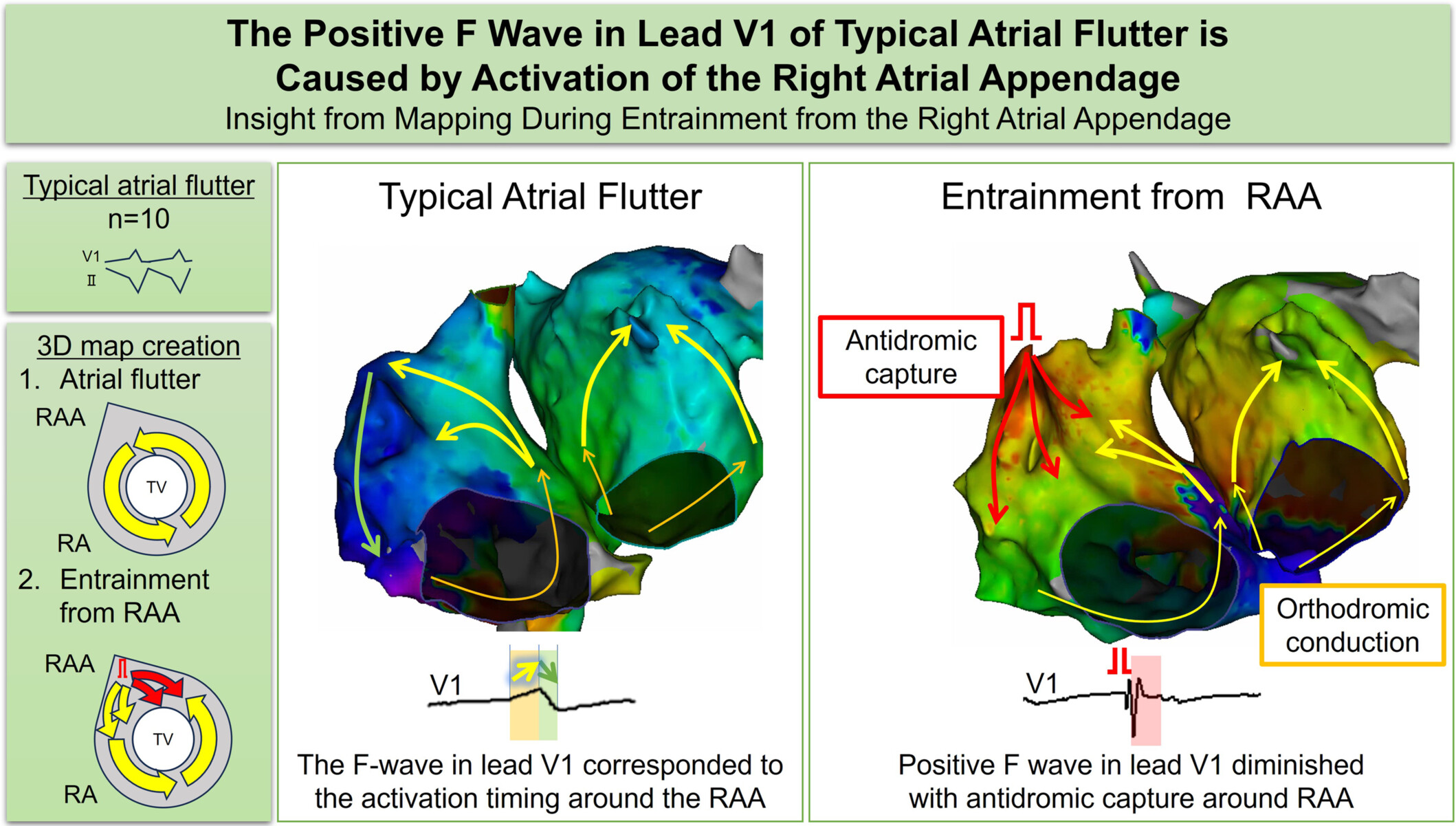 The positive F wave in lead V1 of typical atrial flutter is caused by activation of the right atrial appendage: Insight from mapping during entrainment from the right atrial appendage