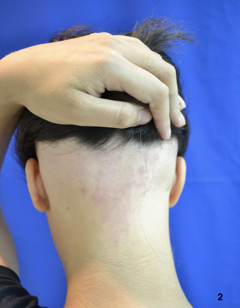 An excellent response to tofacitinib in a Brazilian adolescent patient with alopecia areata: A case report and a review of the literature