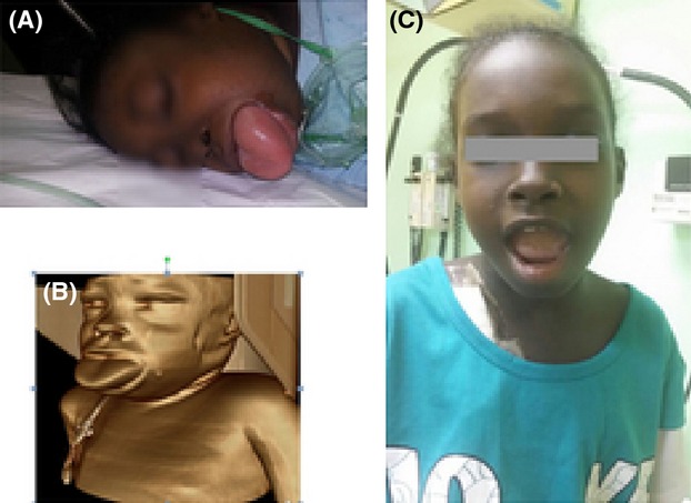 Potentially lethal ACE-inhibitor-induced angioedema in a child