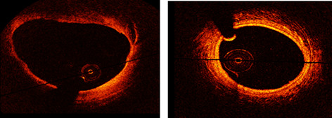 An automatic diagnostic system of coronary artery lesions in Kawasaki disease using intravascular optical coherence tomography imaging