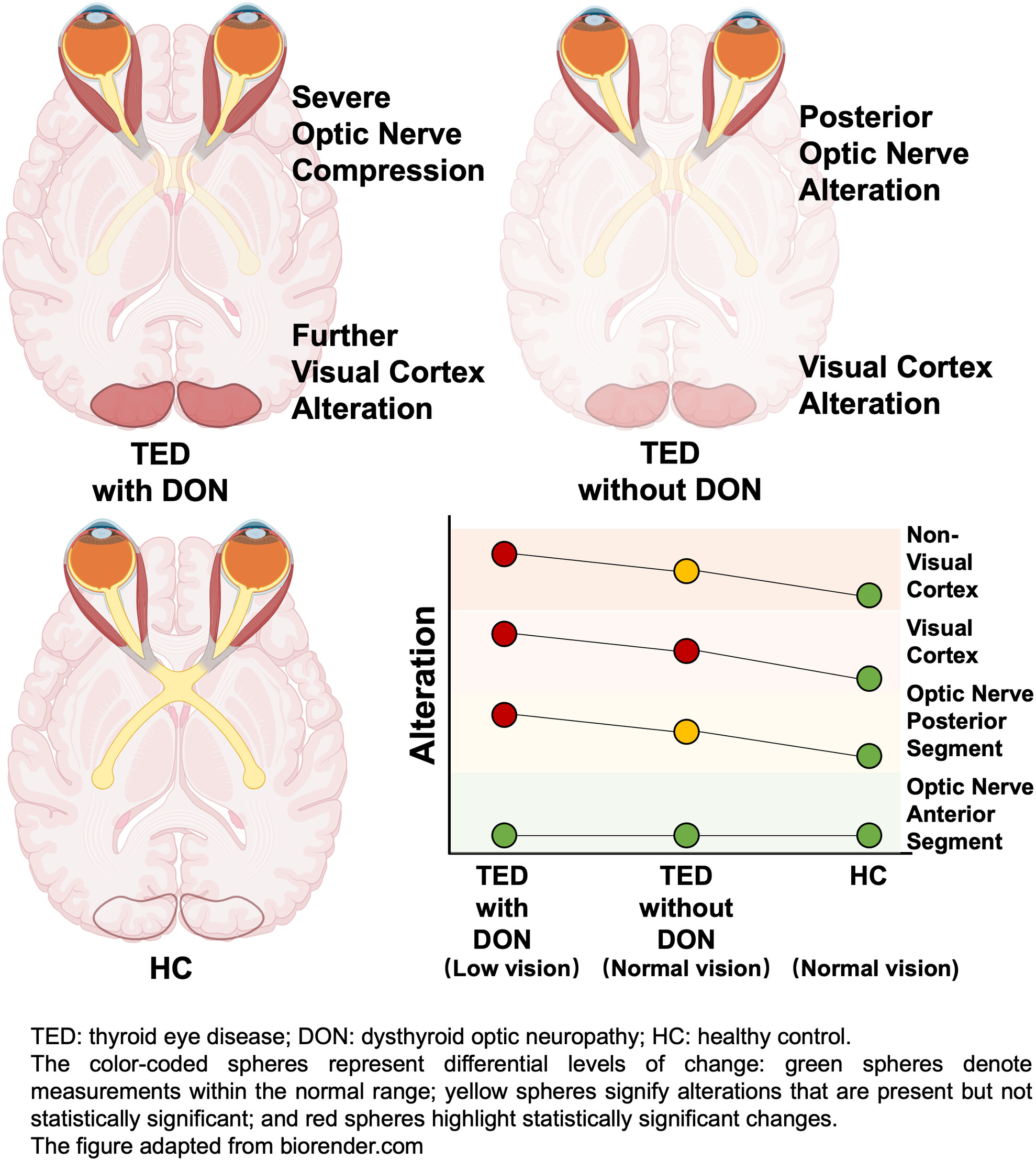 Optic nerve compression associated with visual cortex functional alteration in dysthyroid optic neuropathy: A combined orbital and brain imaging study