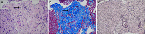Identification and clinical significance of nodular regenerative hyperplasia in primary sclerosing cholangitis