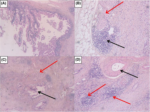 Branch Duct – IPMN and PanIN, in IgG4-Autoimmune pancreatitis: A case report