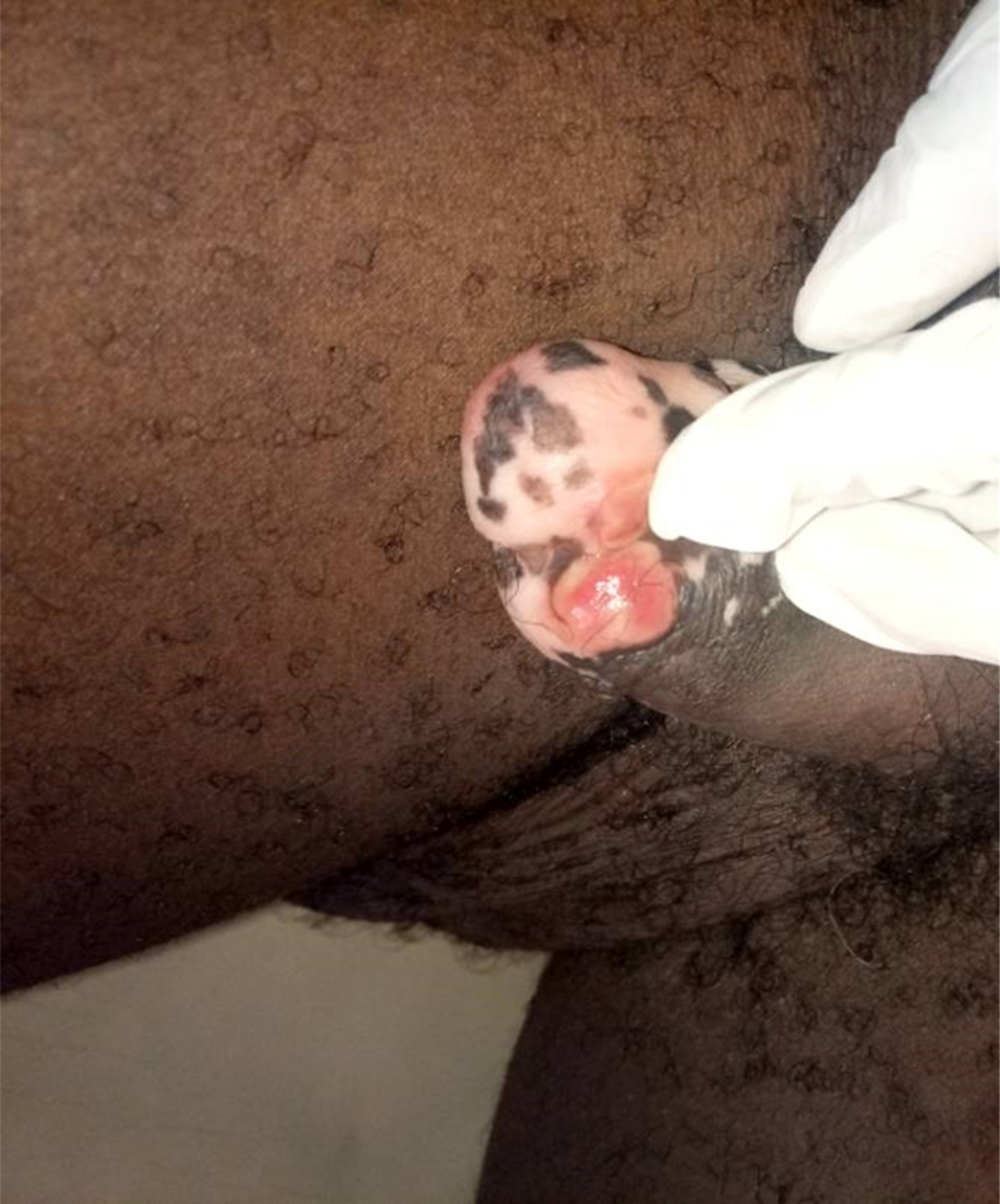 Hypopigmented penile fixed drug eruption