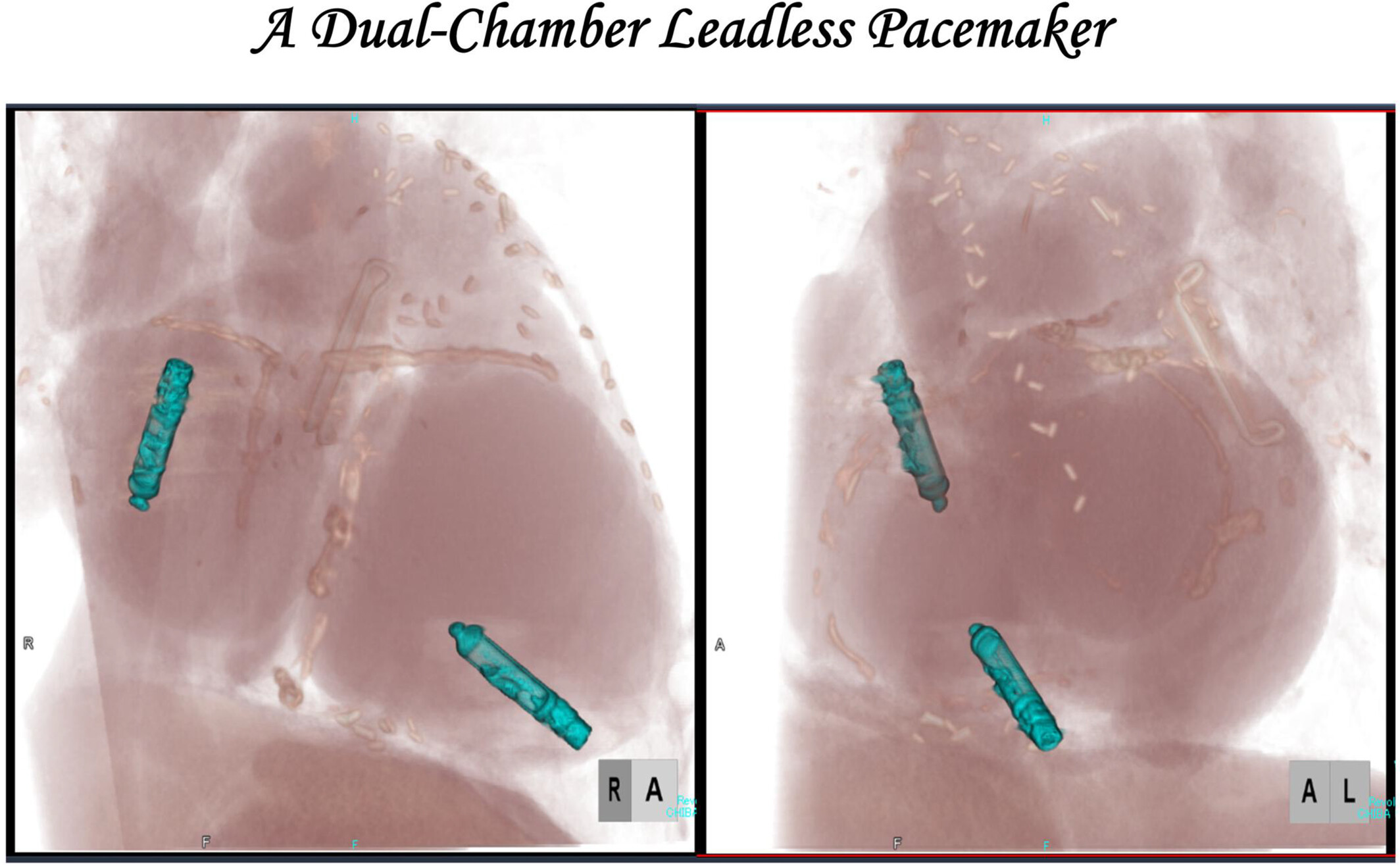 Opening the door to a new era: A dual-chamber leadless pacemaker