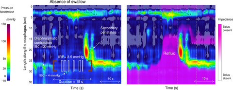 Validation of criteria for the definition of transient lower esophageal sphincter relaxations using high-resolution manometry
