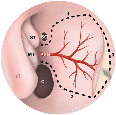 Vascular pedicled flaps for skull base defect reconstruction