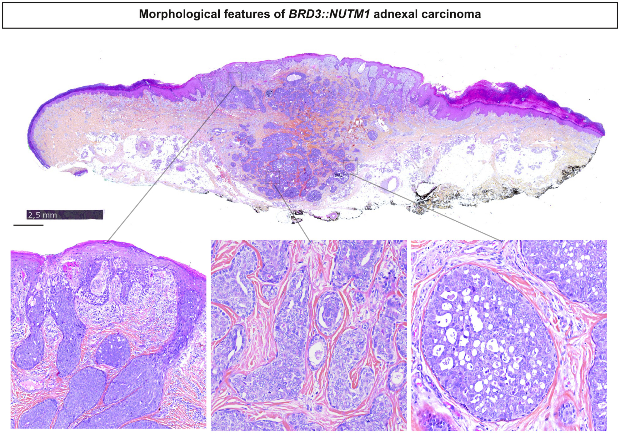 Primary cutaneous NUT adnexal carcinoma: morphologic, genetic and methylation analysis of seven new cases with comparison to extracutaneous NUT carcinoma and NUTM1-rearranged porocarcinoma