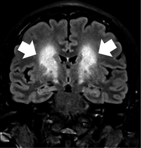 Chronic severe methanol intoxication after repeated mask cleansing due to fear of COVID-19: A new risk of coronaphobia