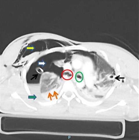 Right main bronchus rupture due to blunt chest trauma