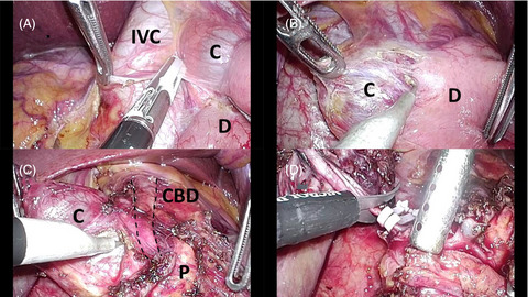 Laparoscopic excision of type II choledochal cyst arising from the intrapancreatic common bile duct in an adult
