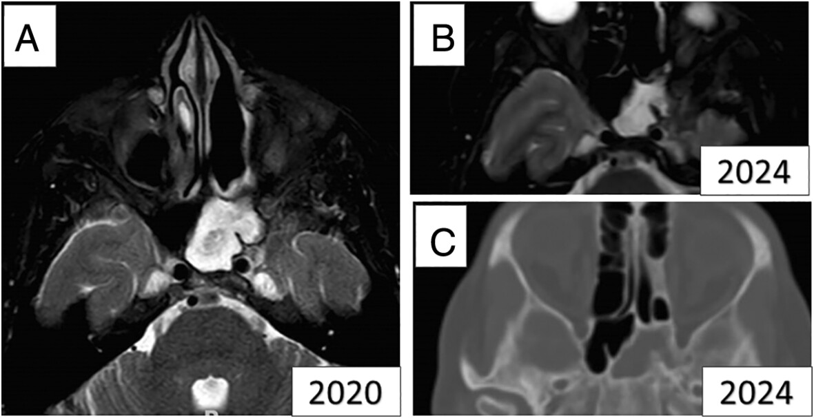 Long-Term Follow-Up of Post Radiation Complete Sinus Opacification in Sinonasal Cancer Patients