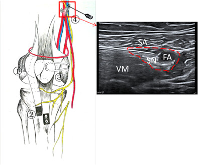 Adductor Canal Block Combined with General Analgesia for Patients with Recurrent Patellar Dislocation Undergoing “3-in-1” Procedure Surgery: A Prospective Randomized Controlled Trial
