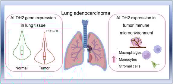Expression pattern and prognostic significance of aldehyde dehydrogenase 2 in lung adenocarcinoma as a potential predictor of immunotherapy efficac graphical abstrac