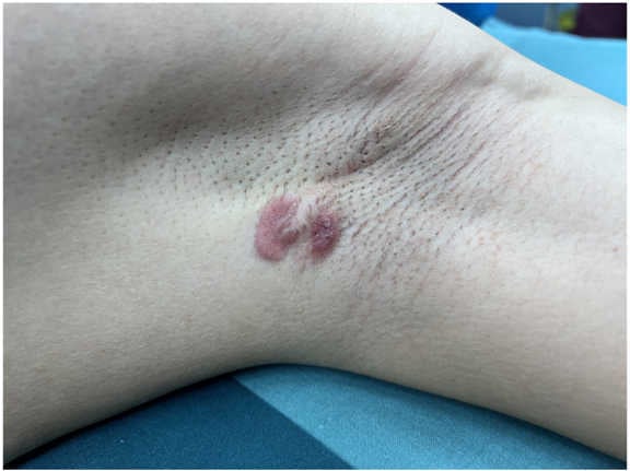 A rare primary cutaneous myoepithelial carcinoma in the axilla accompanied by lymph node metastasis: A case repor graphical abstract