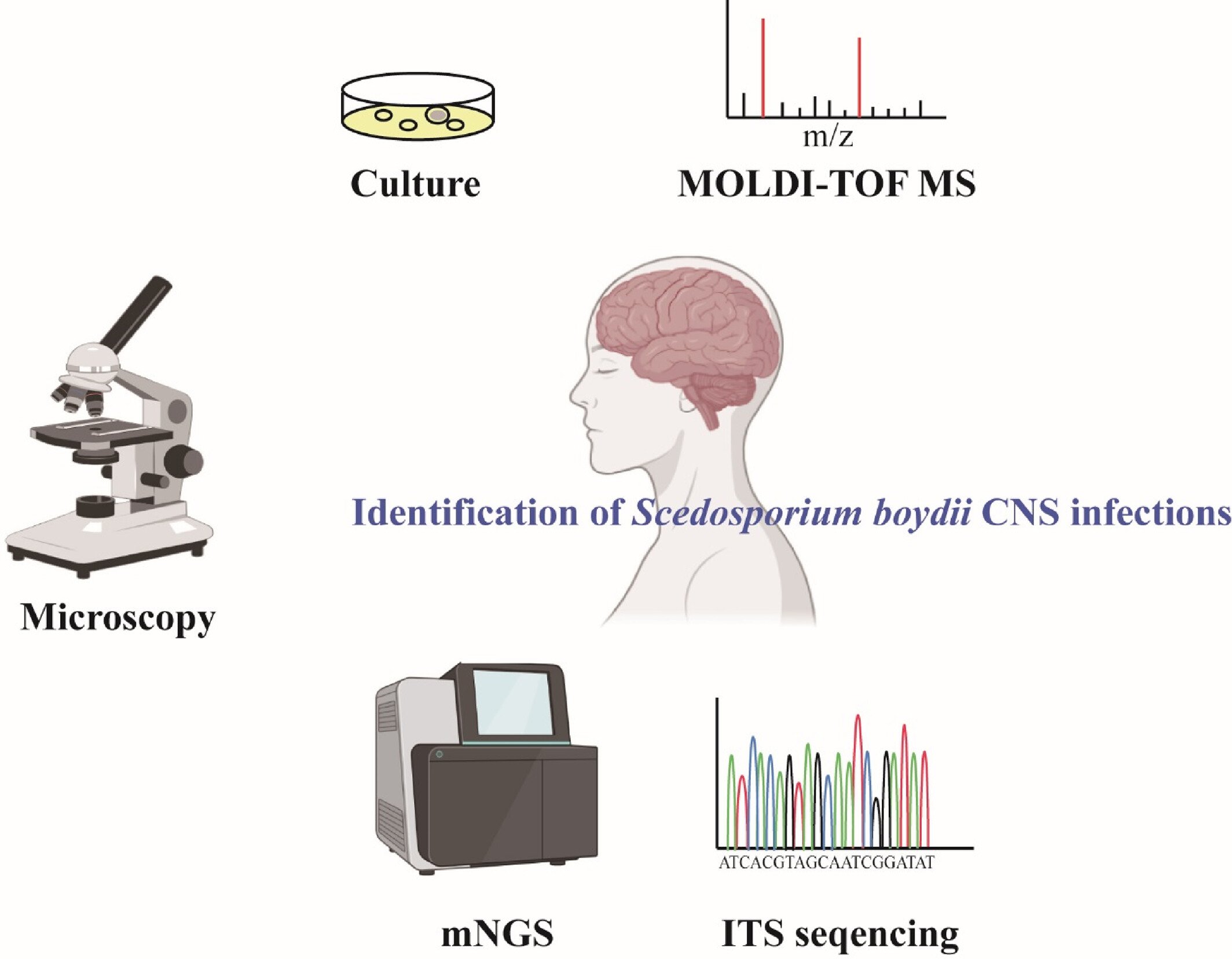 A case of central nervous system infection with Scedosporium boydii
